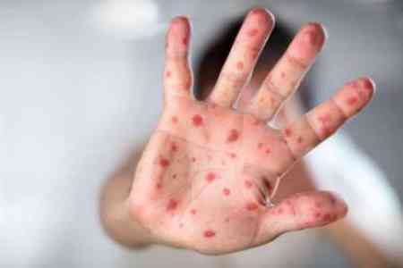 Measles cases recorded in Armenia